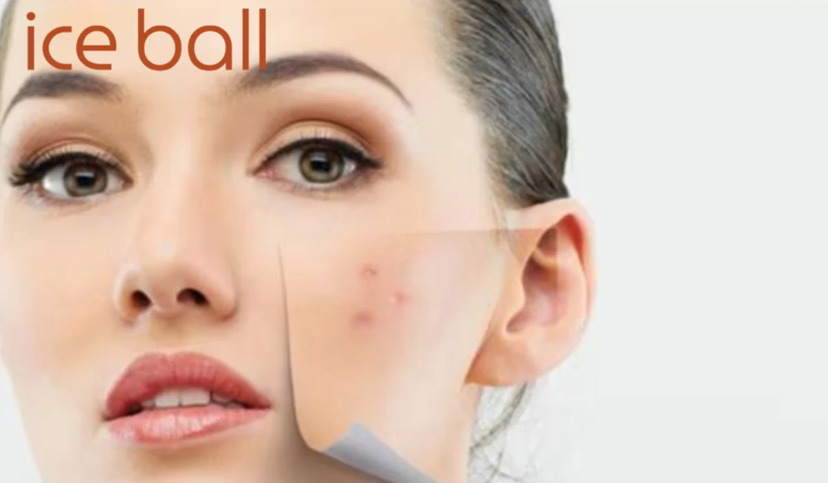 یخ برای رفع جوش صورت