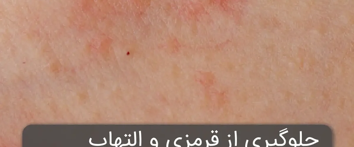 جلوگیری از قرمزی و التهاب بعد از اصلاح صورت
