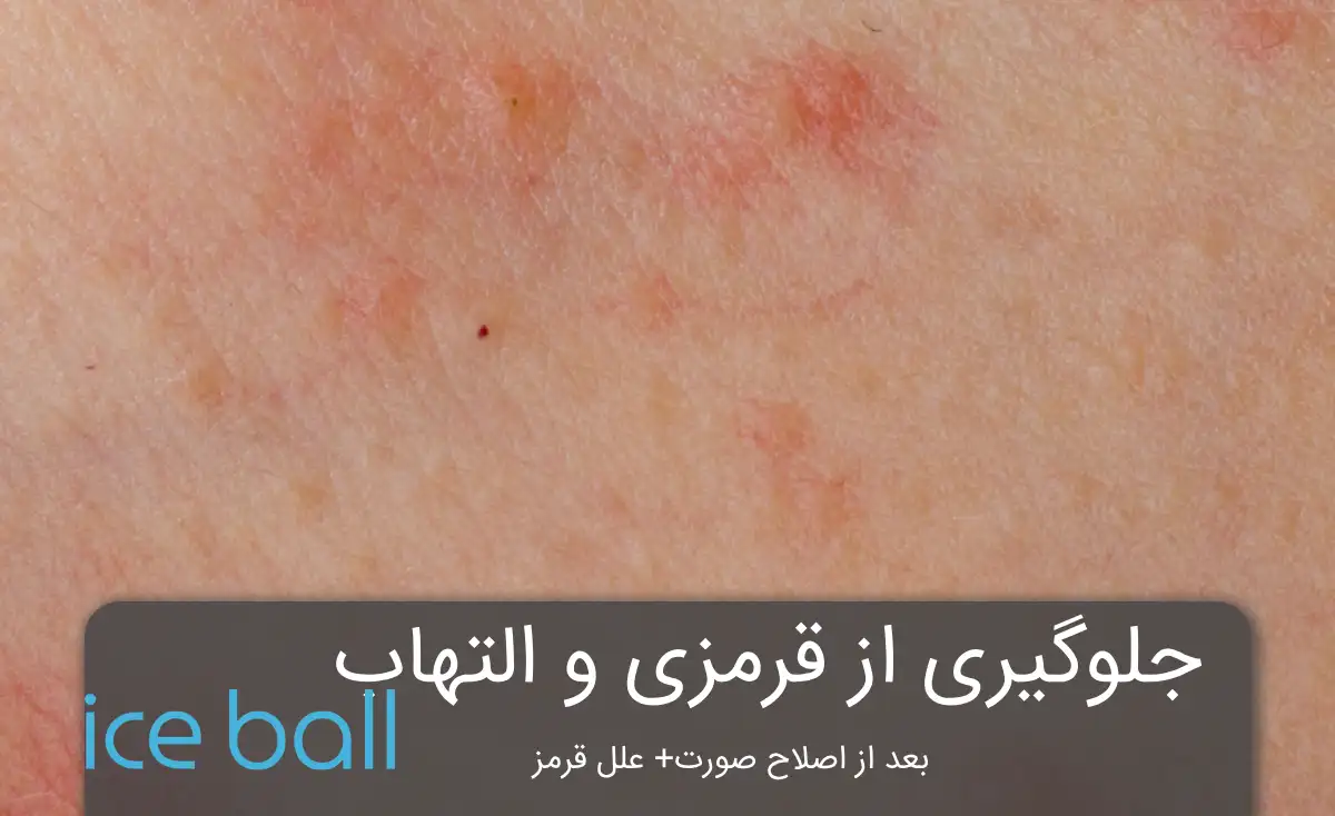 جلوگیری از قرمزی و التهاب بعد از اصلاح صورت