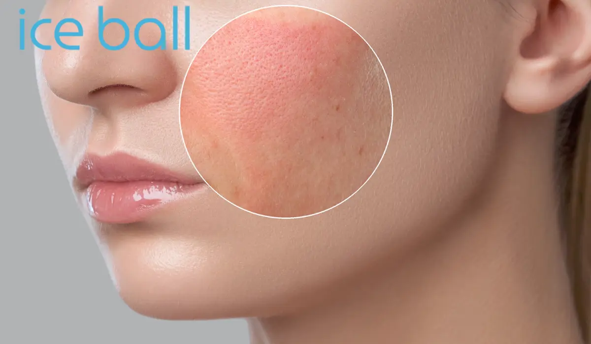 جلوگیری از قرمزی و التهاب بعد از اصلاح صورت