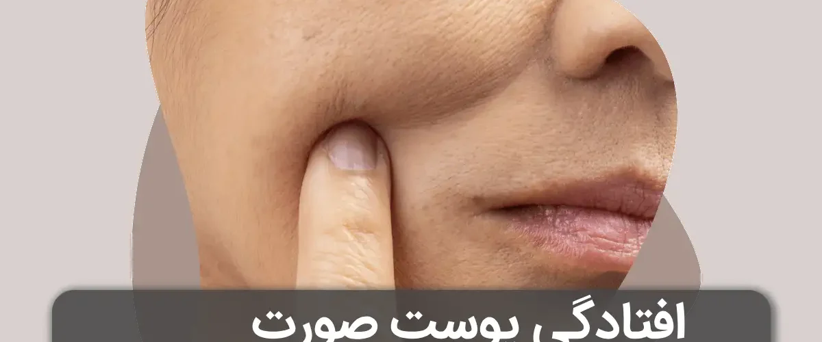 افتادگی پوست صورت