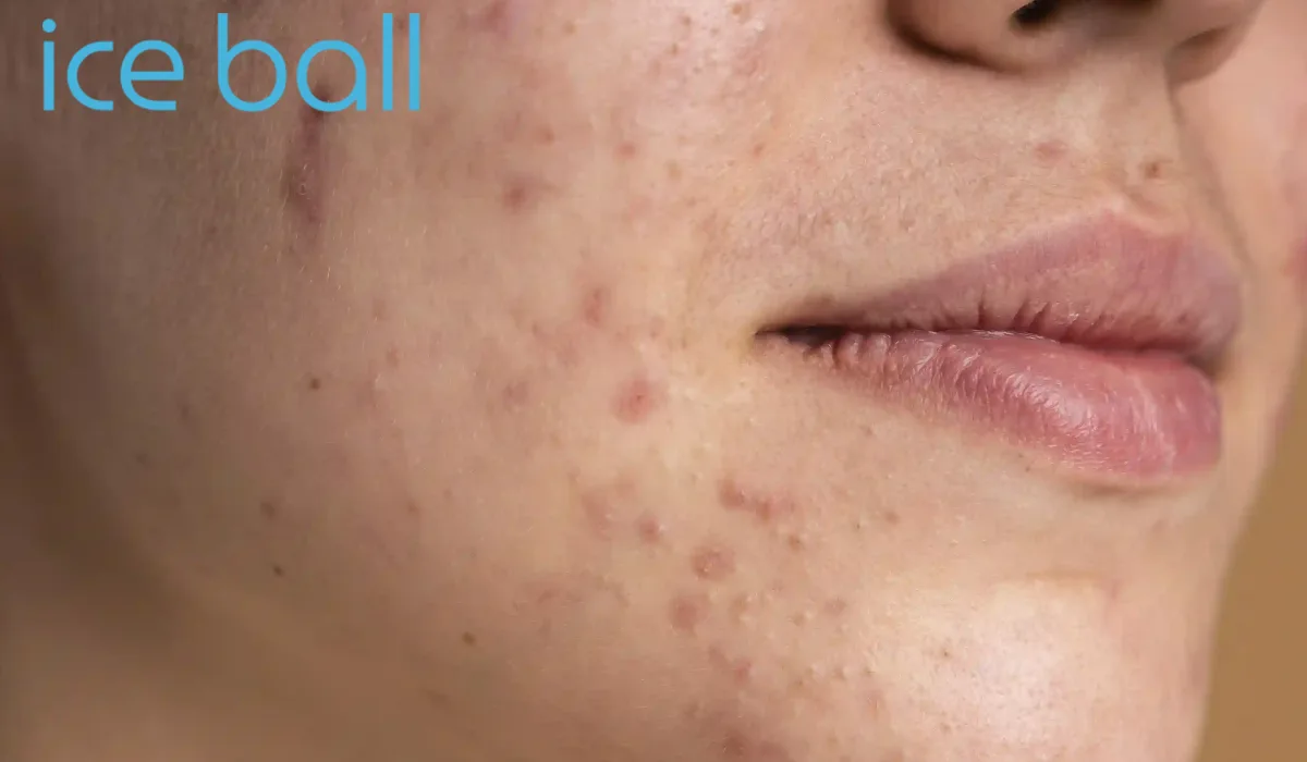 انتخاب آیسبال مناسب