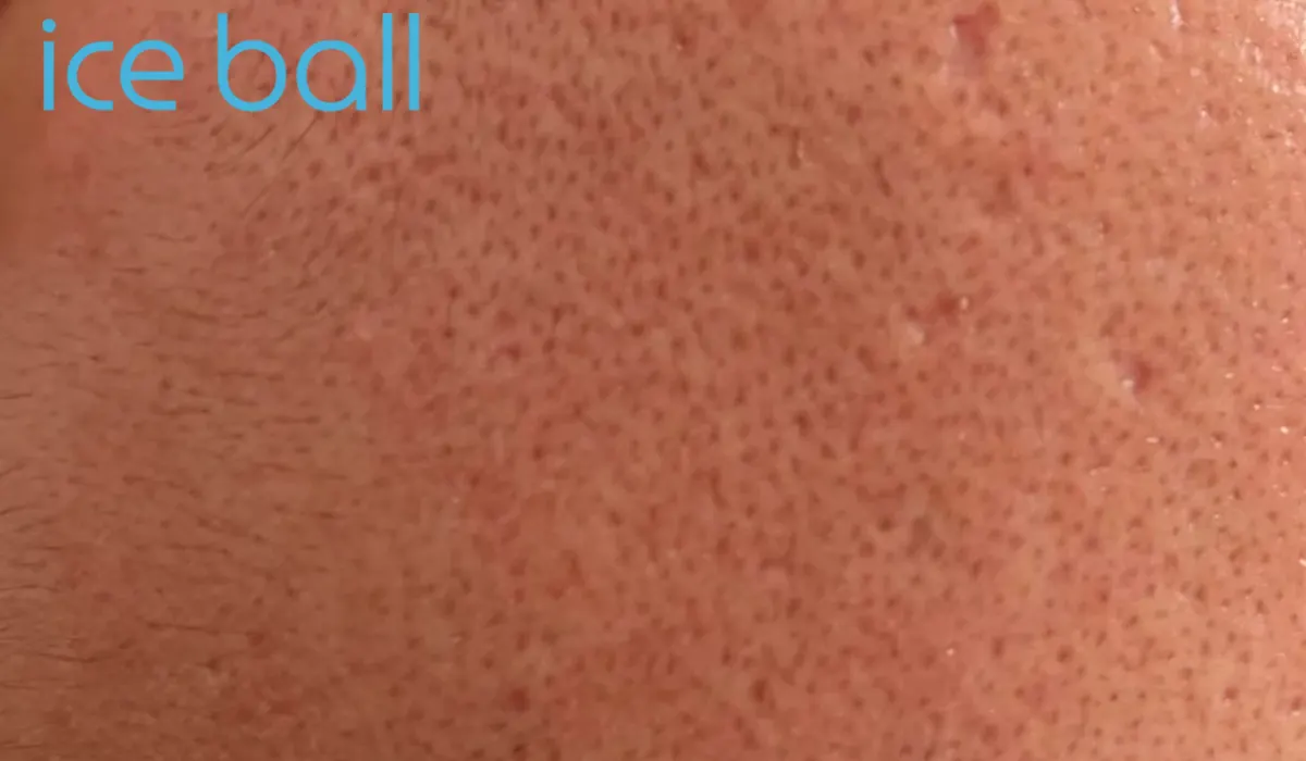 آیس بال چیست