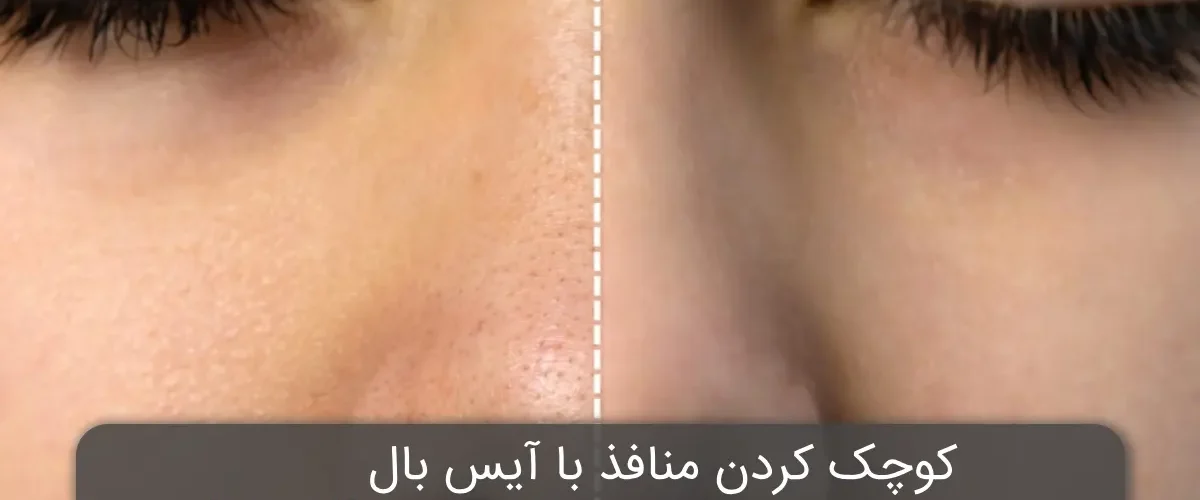 کوچک کردن منافذ با آیس بال